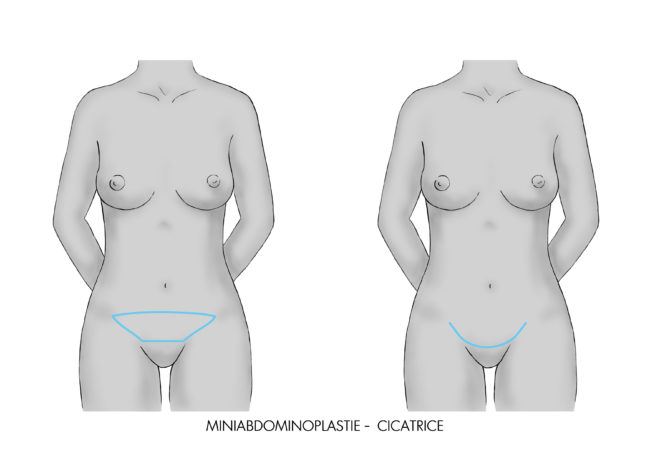 La mini abdomiloplastie à Paris corrige les relâchements musculaires liées à la partie inférieure de l’abdomen, Dr Marsili