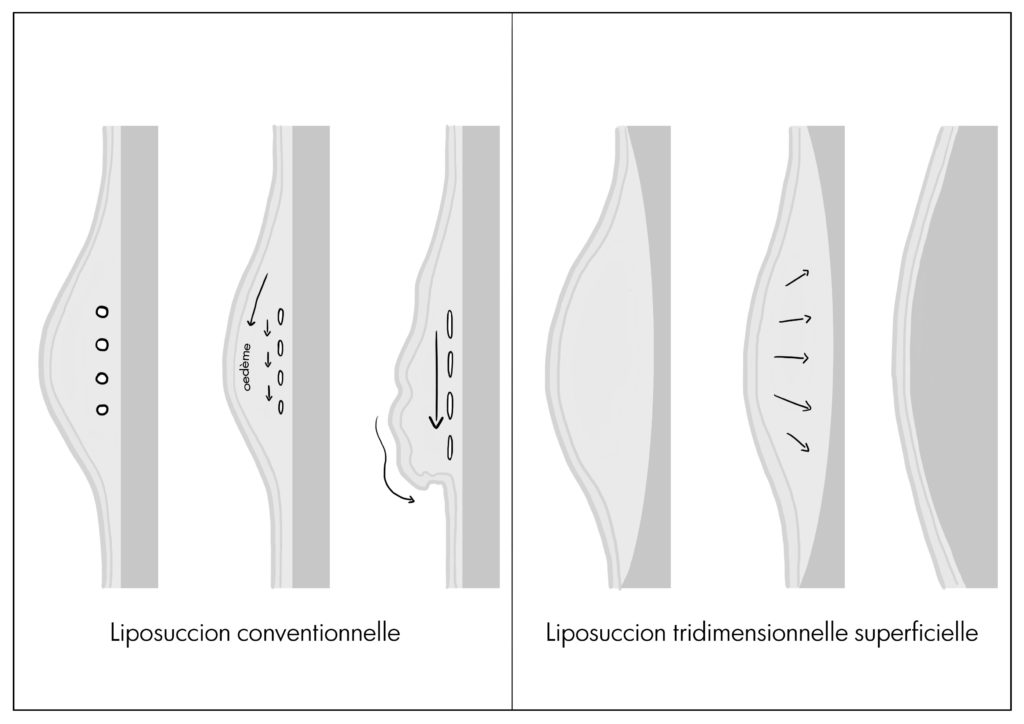 L'intervention de la liposuccion à paris permet d'enlever la graisse localisée, Dr Marsili