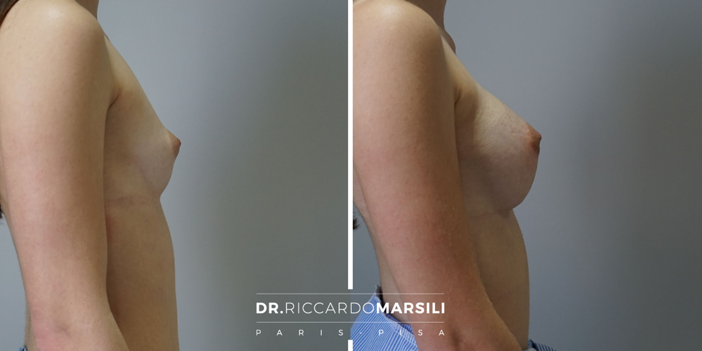 Augmentation mammaire par prothèse à Paris | Dr Marsili