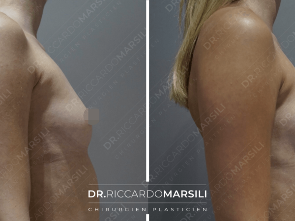 Augmentation mammaire à Paris avant et après