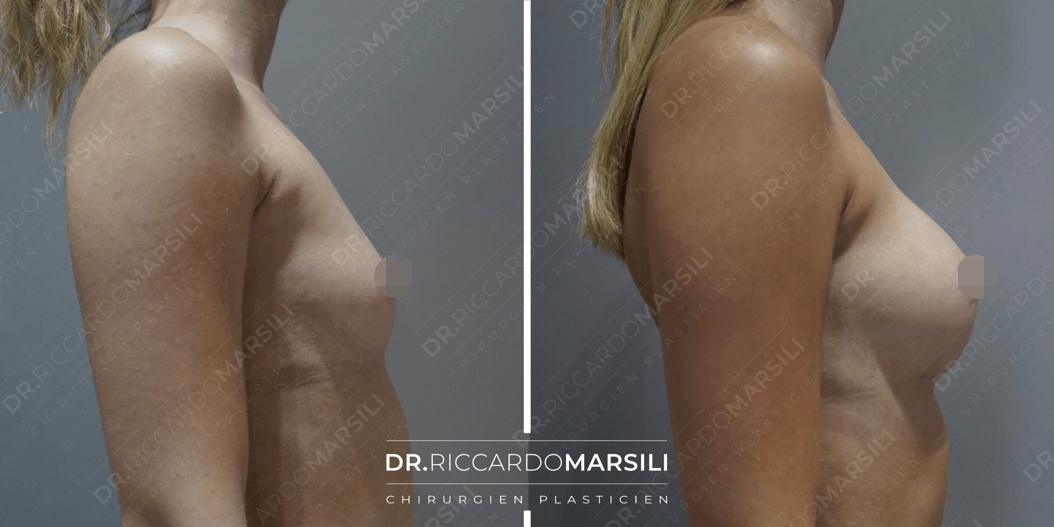 Augmentation mammaire à Paris avant et après