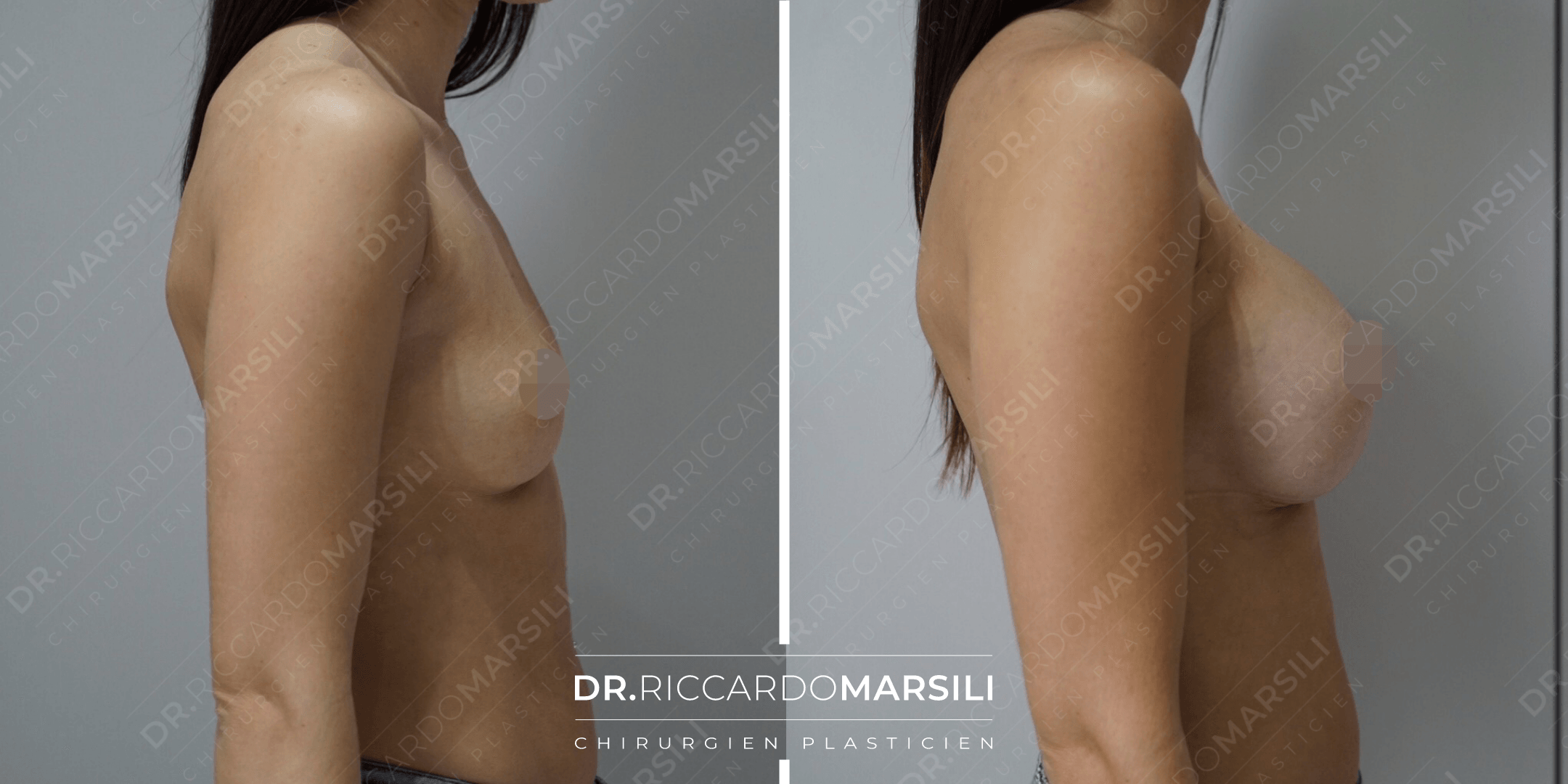 Augmentation mammaire avant après photos