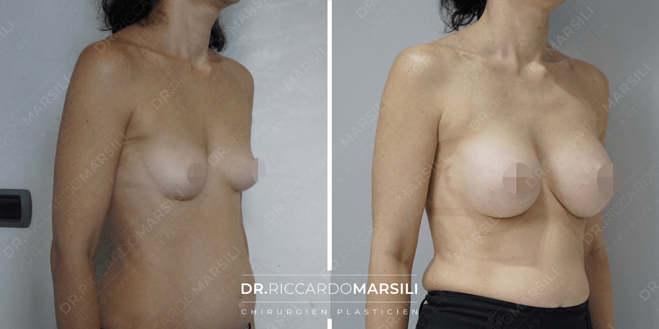 Augmentation mammaire Paris avant et après