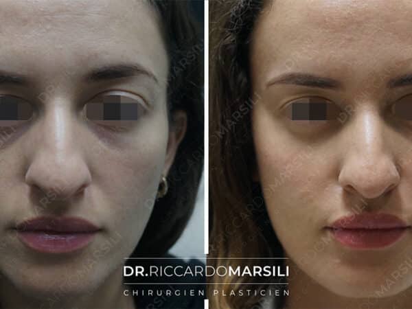 avant apres lifting visage sans chirurgie 3 dr marsili