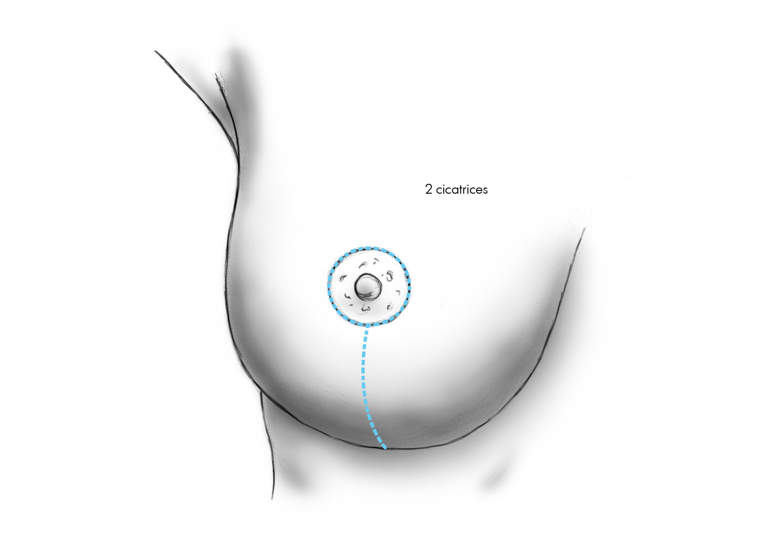 Les techniques chirurgicales de réduction mammaire par Dr Marsili