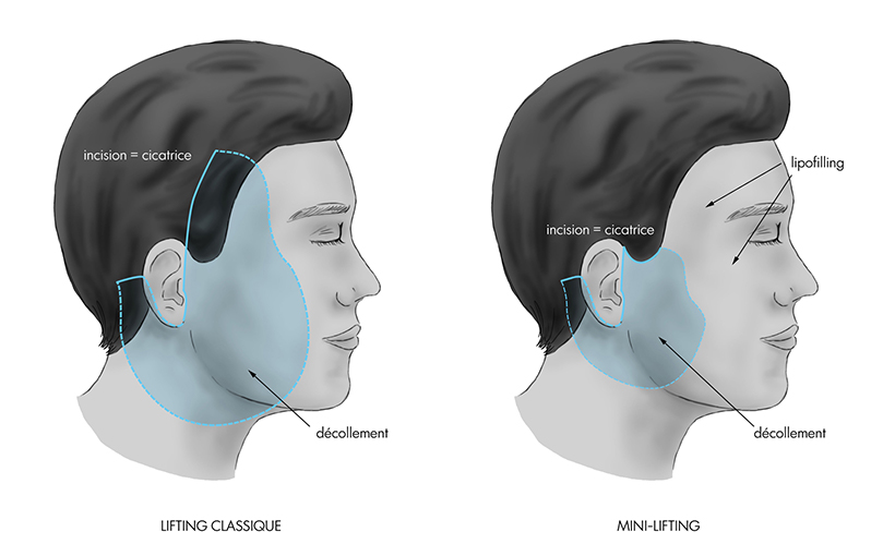 Obtenir un aspect frais et plus jeune du visage avec le mini-lifting à paris, Dr Marsili