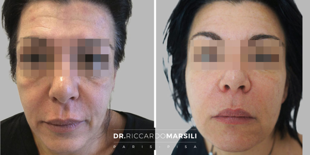 Rajeunir le visage sans chirurgie à paris, Dr Riccardo Marsili
