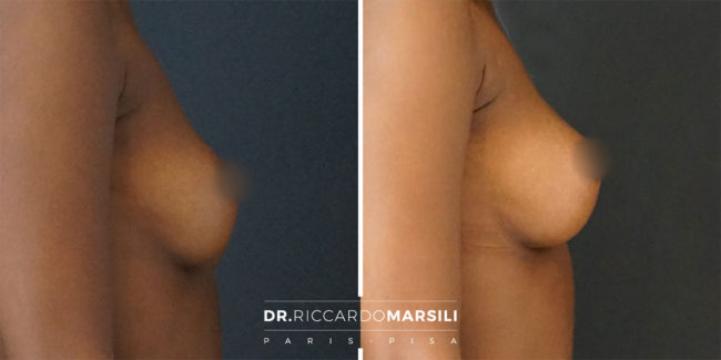 Lipofilling Mammaire Paris