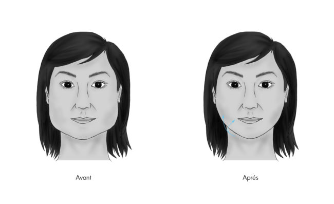 Améliorer le contour inférieur du visage par les Injections de toxine botulique à paris, Dr Marsili