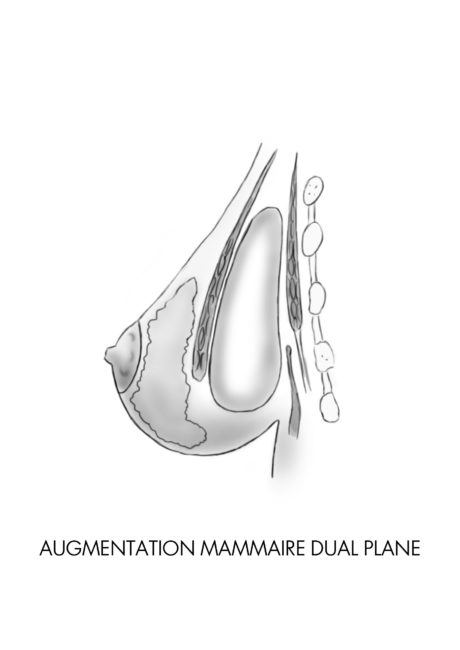 L'augmentation mammaire : les avantages de la technique Dual Plane, Dr Riccardo Marsili à paris
