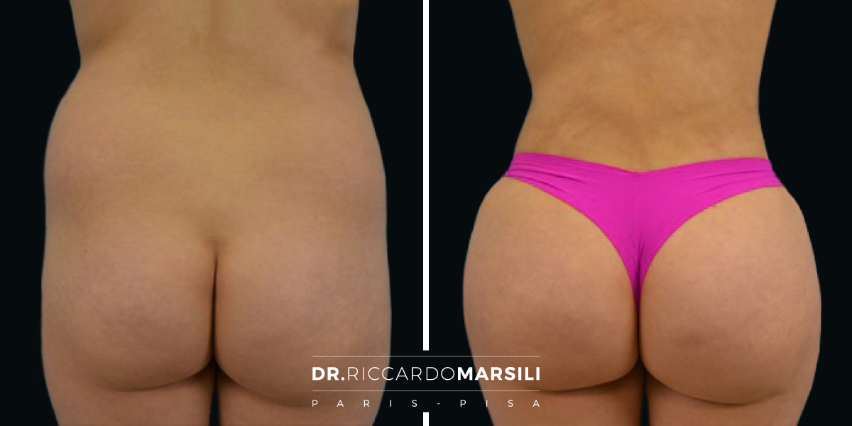 Augmentation des fesses par la glutéoplastie (Lipofilling) à paris Dr Marsili