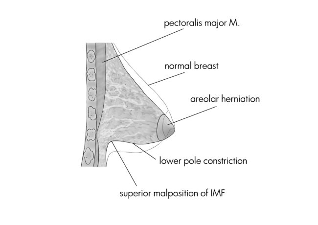 La chirurgie esthétique des seins : Correction des malformation mammaires à paris, Dr Marsili