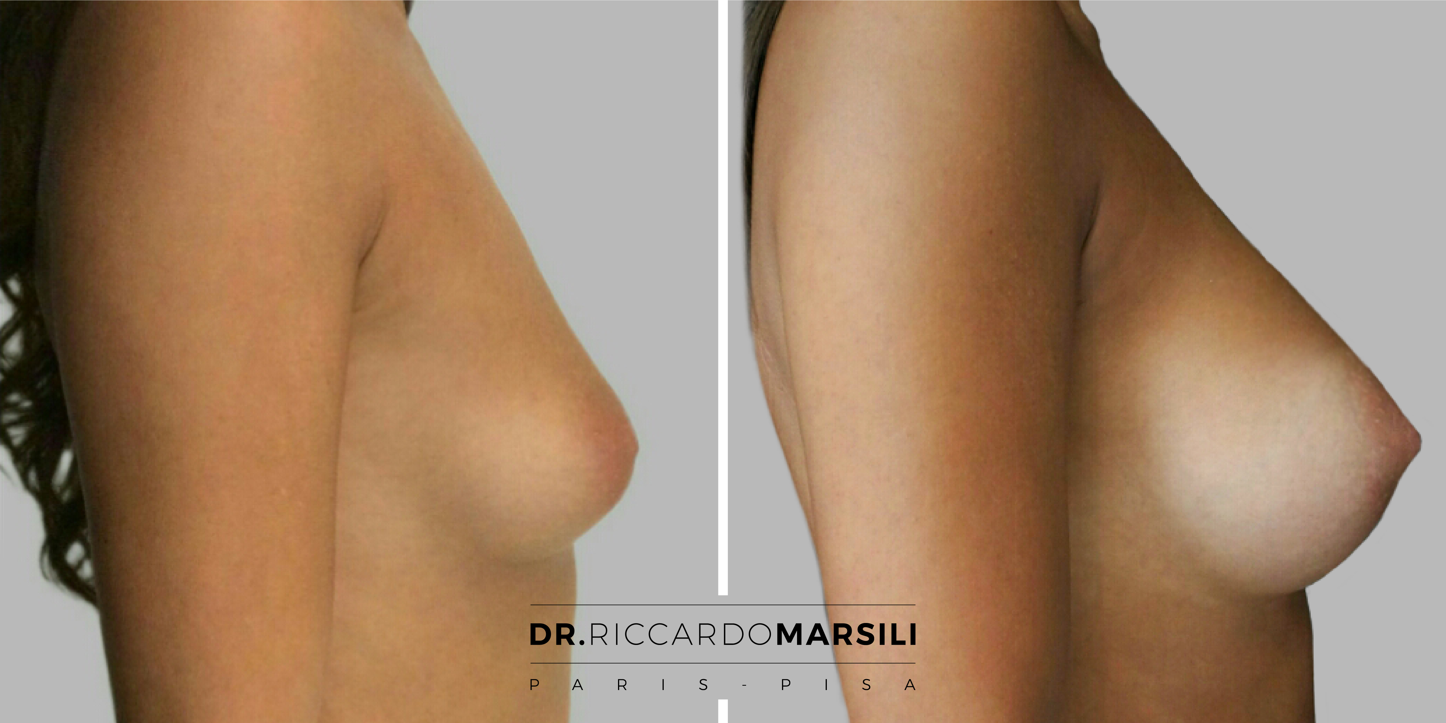 Chirurgie esthétique :Augmentation mammaire à paris , Dr Riccardo Marsili