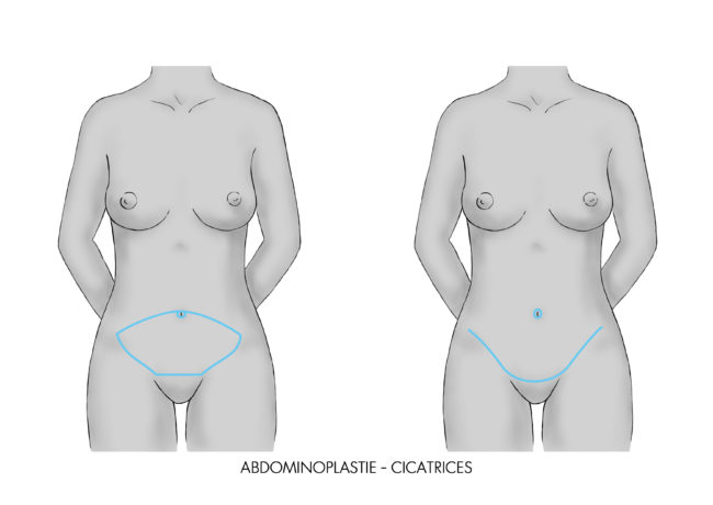 Abdominoplastie Paris