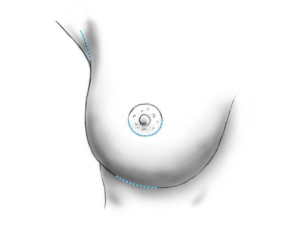 L'augmentation de la taille des seins par l'implantation des implants mammaires à paris, Dr Marsili