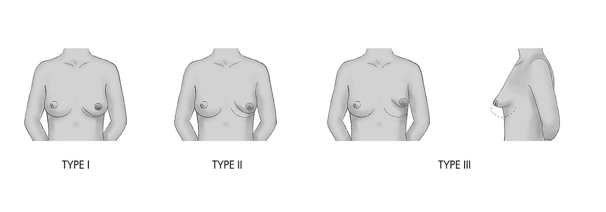 La correction de la malformation congénitale des seins à paris par le Dr Riccardo Marsili