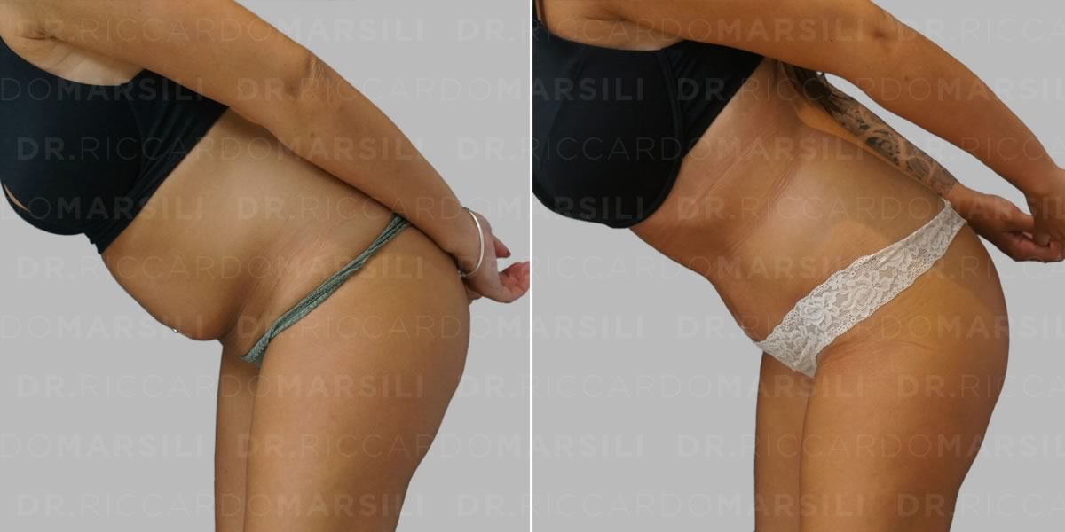 La chirurgie esthétique du ventre par le Dr Riccardo Marsili à paris